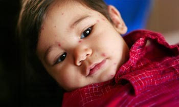 Child with Chicken Pox
